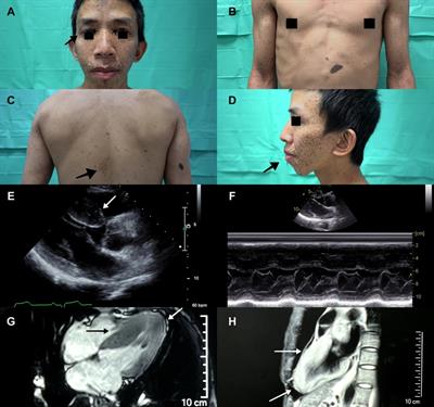 Case report: Distinctive cardiac features and phenotypic characteristics of Noonan syndrome with multiple lentigines among three generations in one family